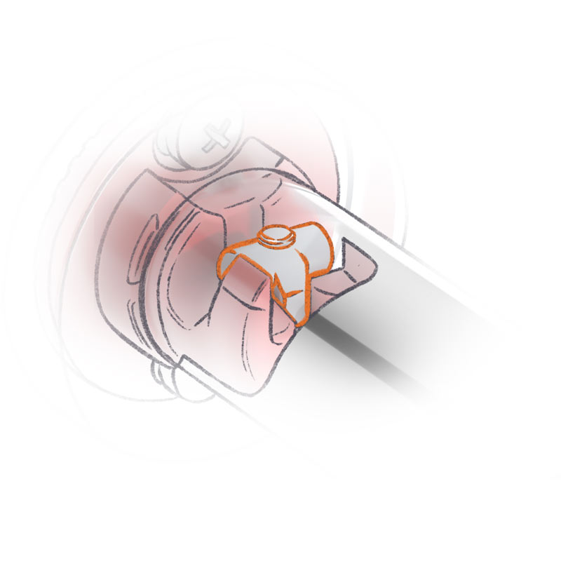 Illustration of Rigid Loc